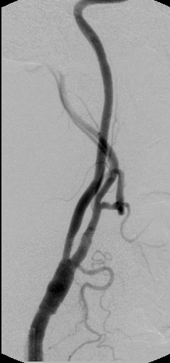 Carotid Artery after Stenting