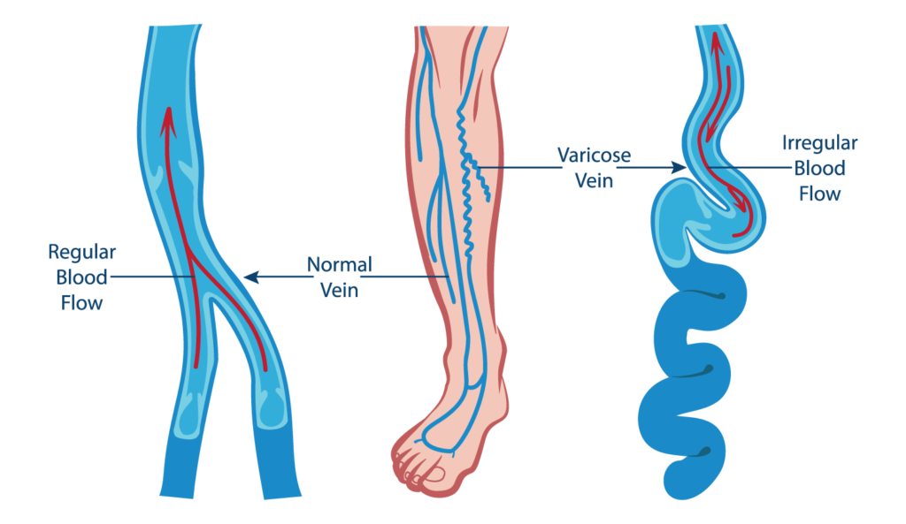 varicose-veins-vascular-care-wa